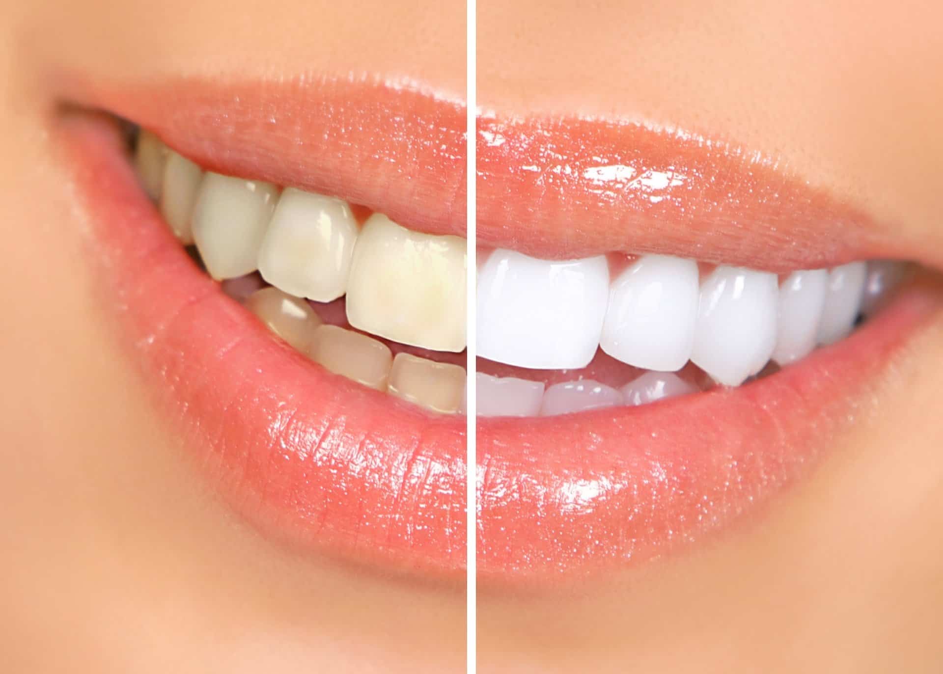Tooth Whitening image