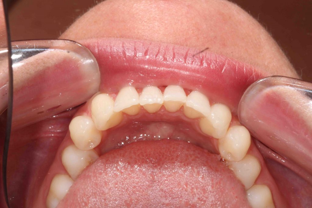 Invisalign Horsham - Clear Aligner Treatment | Holbrook Dental and ...